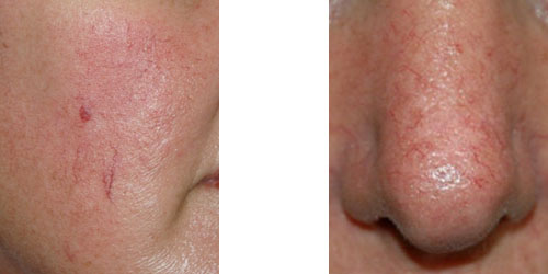 What causes broken facial capillaries?