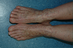 skin vein veins clinic sydney why