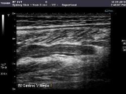 blood clot in leg ultrasound